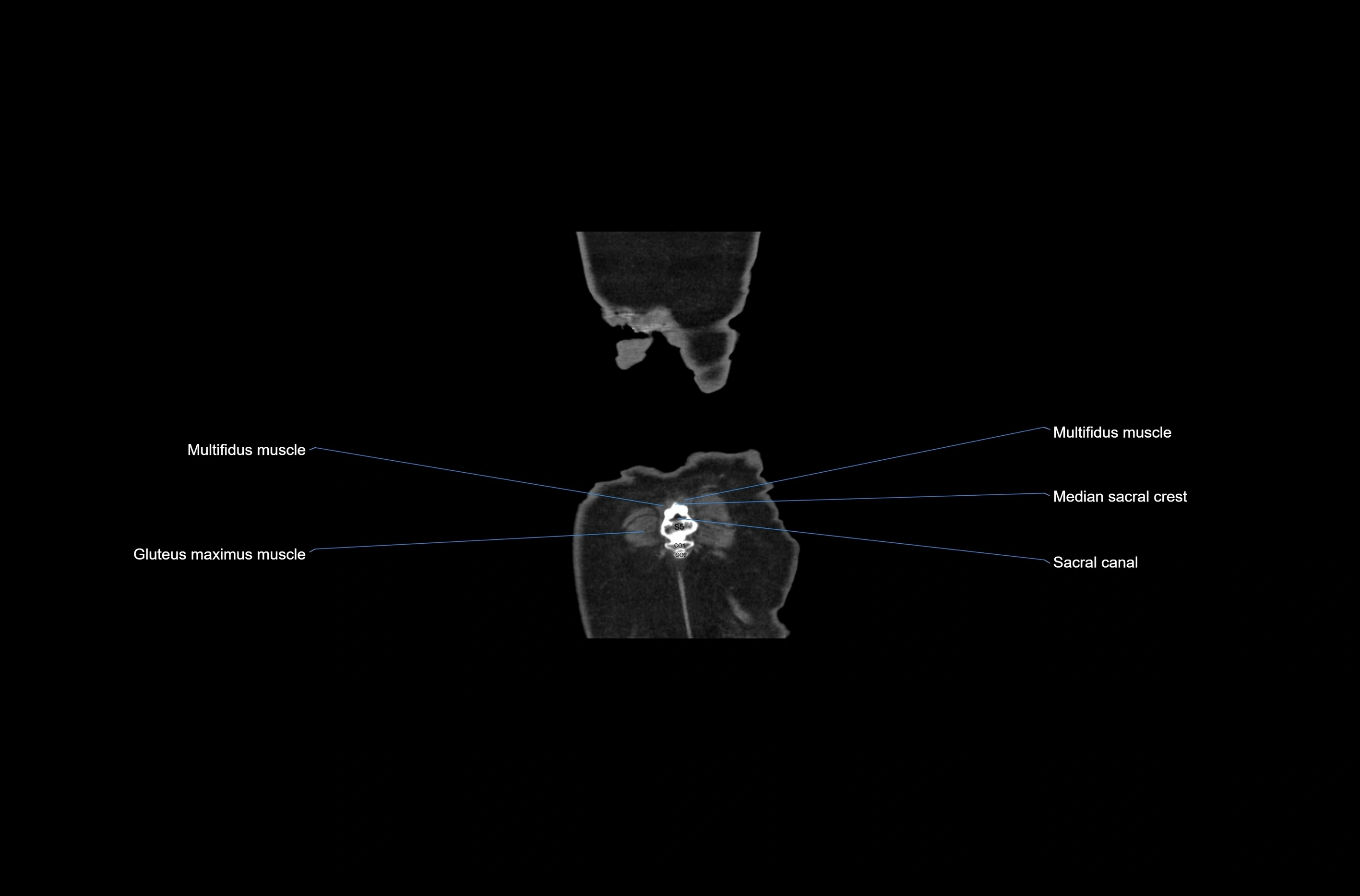 CT abdomen coronal cross sectional anatomy labelled radiology image-00084.webp
